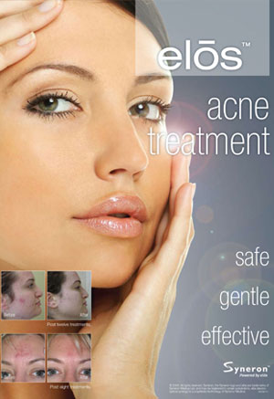 acne treatment in the Lewis-Clark Valley